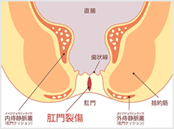 切れ痔が悪化すると刃物で肛門をえぐられるような痛みに悩まされ、肛門が狭くなってしまう肛門狭窄（こうもんきょうさく）という症状に発展する場合もある